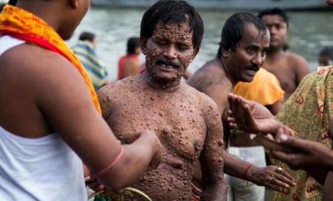 Проказа: історія хвороби і середньовічних помилок