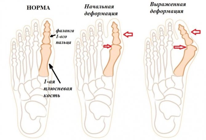 вальгусна деформація