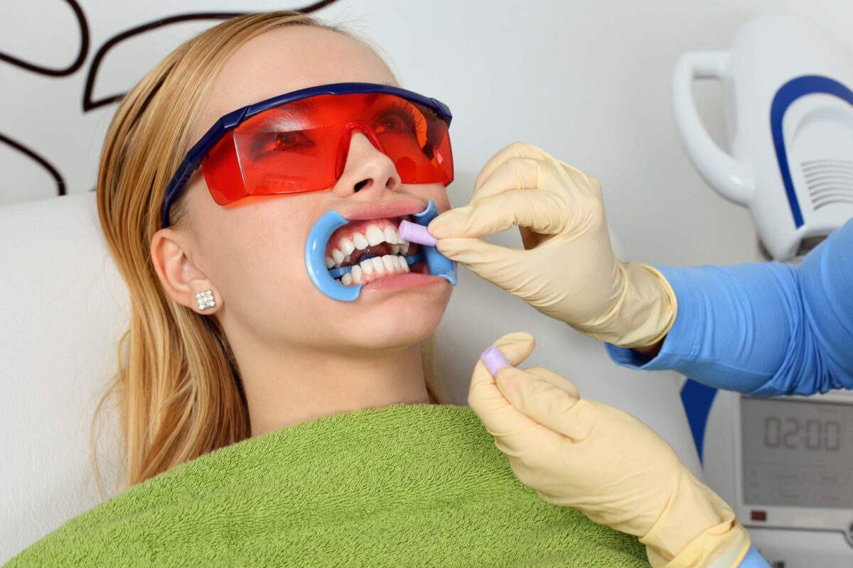 Хімічне відбілювання зубів стоматолог