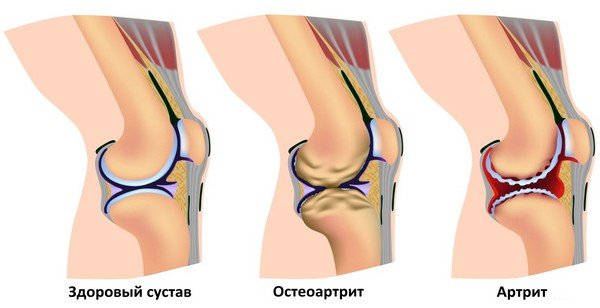 види артриту