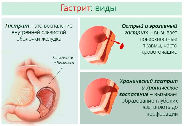 види гастриту