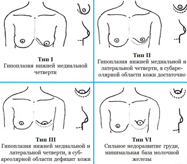 Види гіпоплазії грудей