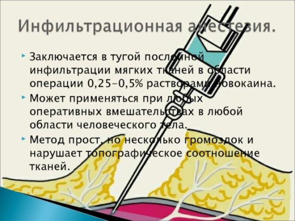 Види інфільтраційної анестезії в стоматології