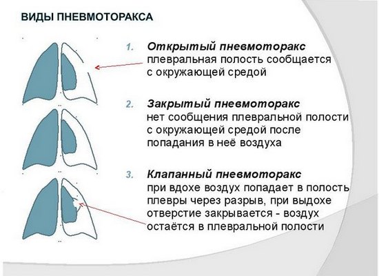 види пневмотораксу