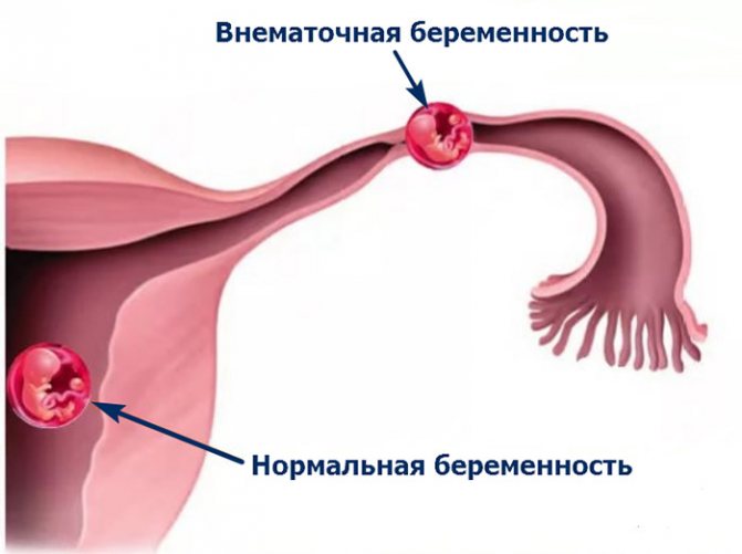 позаматкова вагітність