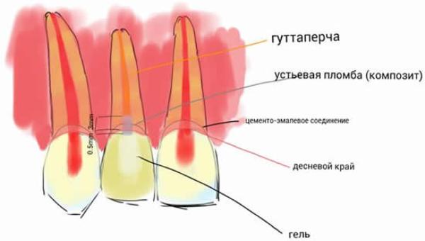 Відбілювання мертвого зуба: чи можна відбілити потемнілий зуб і як правильно це зробити