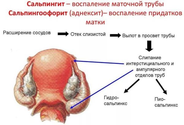 Запалення матки і придатків.  Симптоми і лікування, що це таке, причини, препарати, таблетки, народні засоби