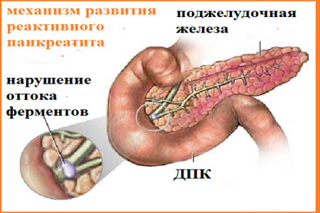 Запалення підшлункової залози симптоми і лікування