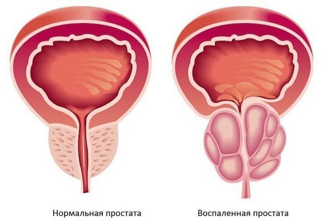 запалення простати