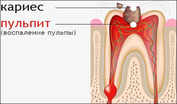 запалення пульпи