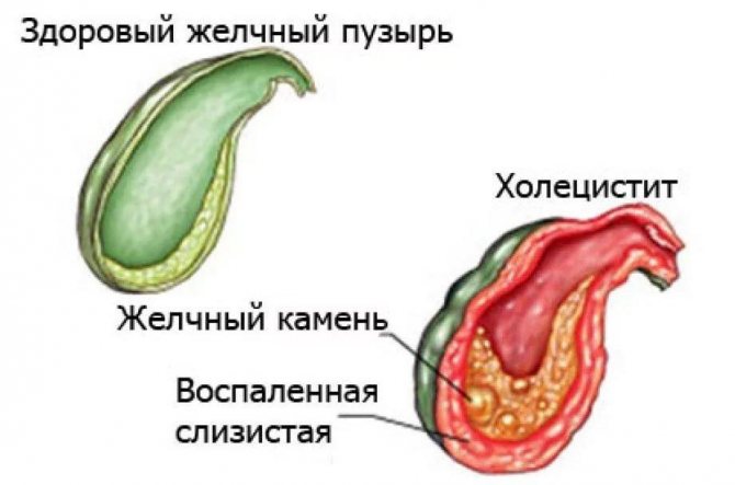 Запалення жовчного міхура