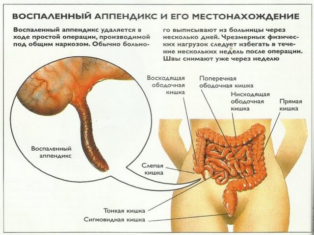 запалений апендицит