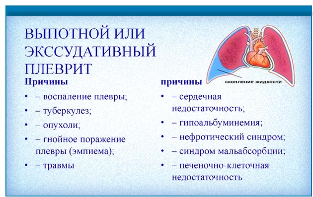 випітної або ексудативний плеврит