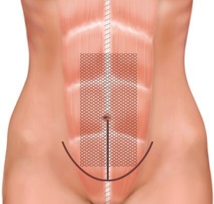 Як позбутися від діастазою? Підбірка корисних вправ