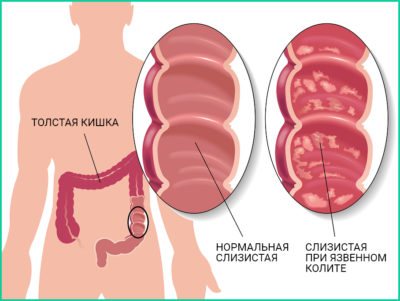 Виразковий коліт і хвороба Крона