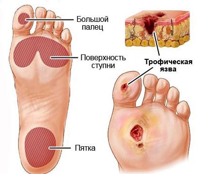 Стопа діабетична: ознаки, лікування і профілактика