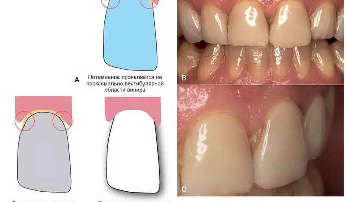 Препарування зубів під вініри: техніка та необхідність обточування