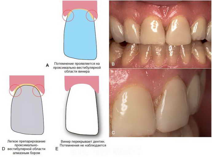 Препарування зубів під вініри: техніка та необхідність обточування