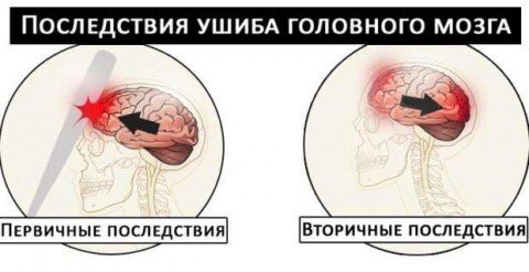 Закрита черепно-мозкова травма струс головного мозку, забій головного мозку, внутрішньочерепні гематоми і т.д.