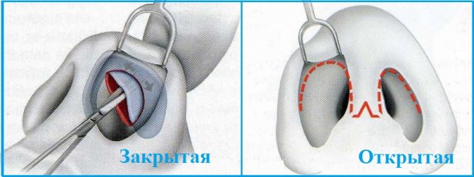 Закрита і відкрита ринопластика кінчика носа