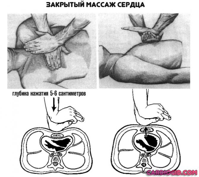 Як розпізнати заздалегідь інфаркт – Все про гіпертонію