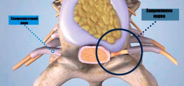 Защемлення нерва: симптоми і лікування