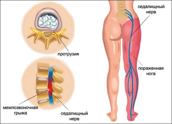 Защемлення нерва: симптоми і лікування