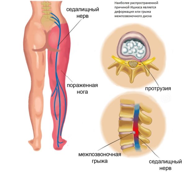 Защемлення сідничного нерва - нерідке явище для сучасної людини