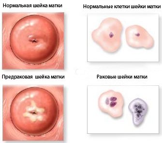 Рідинна цитологія шийки матки.  Що це таке, розшифровка результатів, таблиця, як береться, що показує