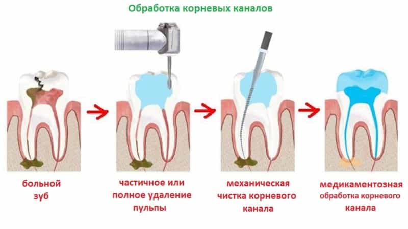 зубні канали